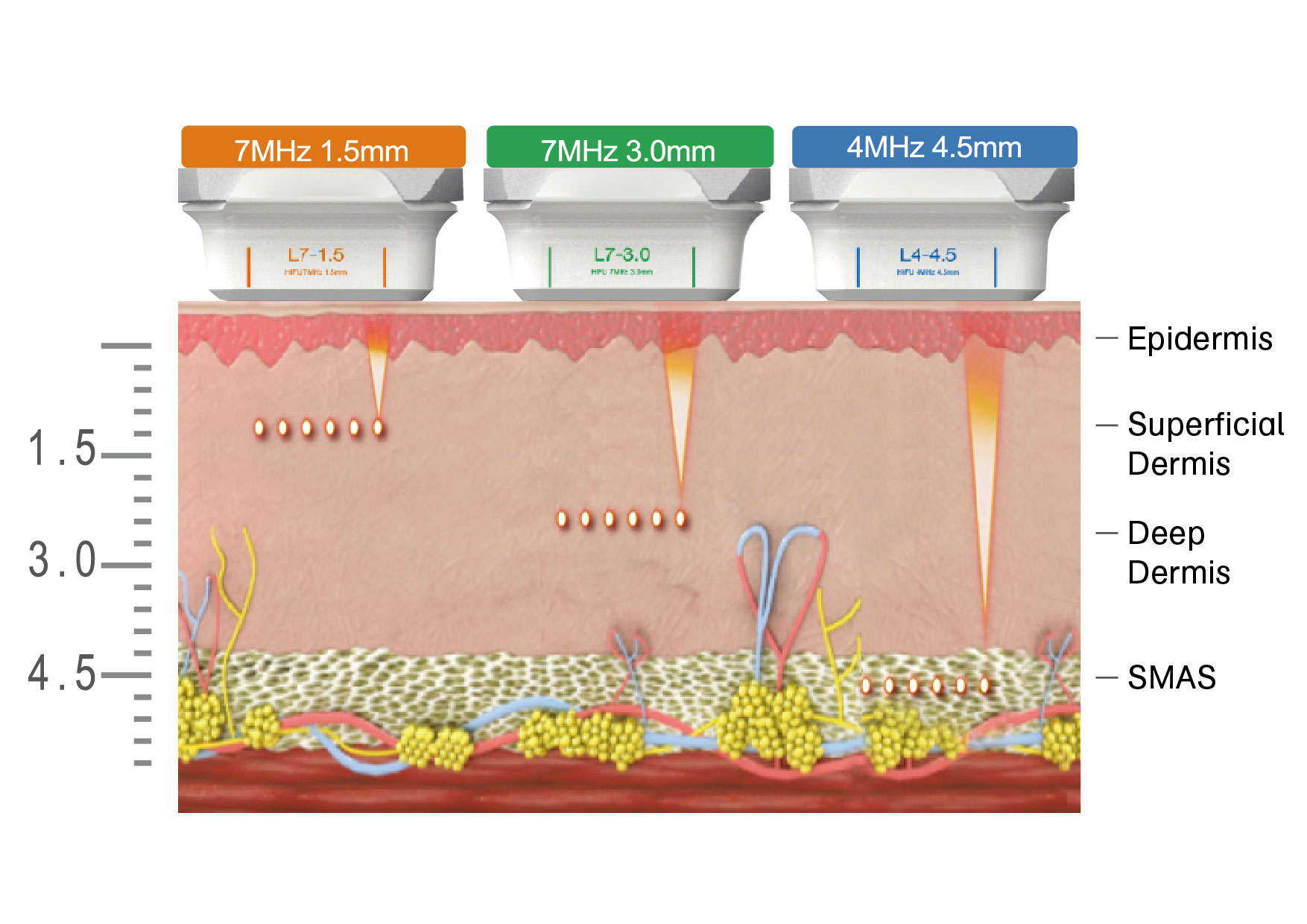 HIFU-illustration.jpg HIFU-illustration.jpg